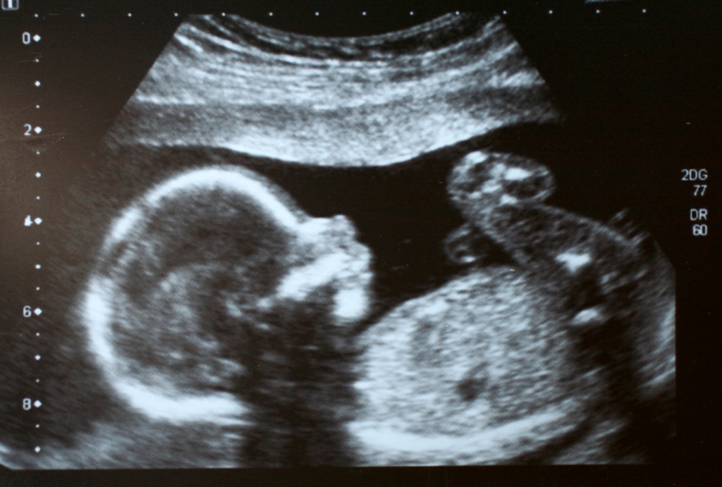 2D Ultrasound Image